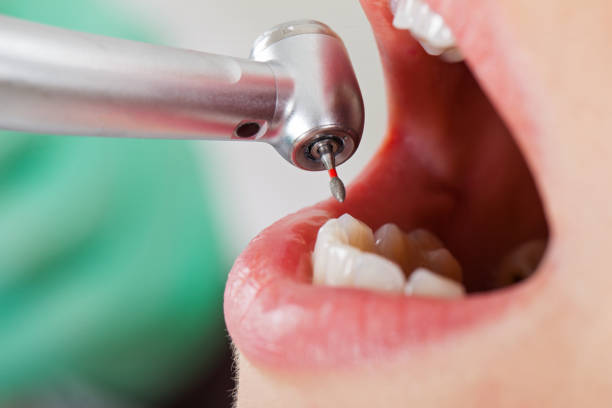 Best Emergency Tooth Extraction in Saegertown, PA